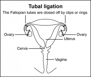 Tubal-ligation-labeled-box
